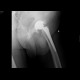 Failure of the hip replacement: X-ray - Plain radiograph